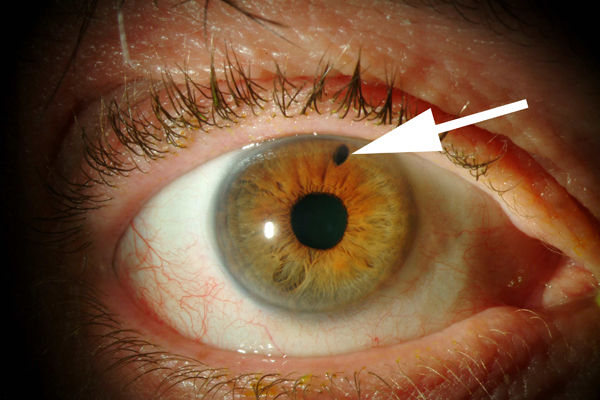 close up of eye with acute angle glaucoma